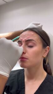 botox specials near me
