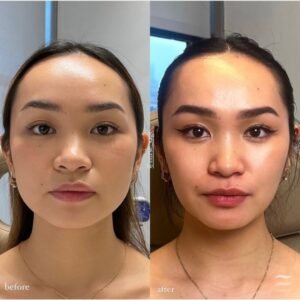masseter botox near me.